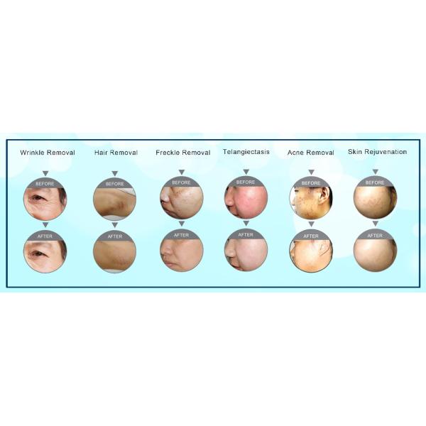 CE Approval Portable IPL RF Elight Hair Removal Machine 3 In 1 Multifunctional