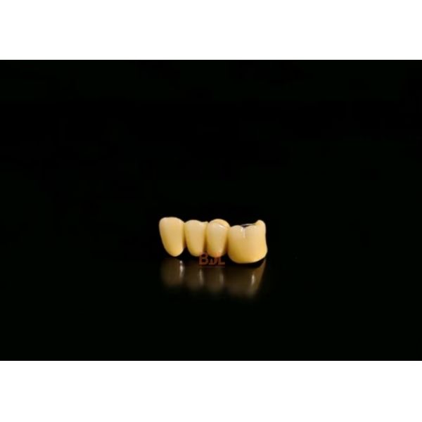 Durable Porcelain Fused To Metal Crown Customized Shade Matching Long Lasting Dental Restoration Solution