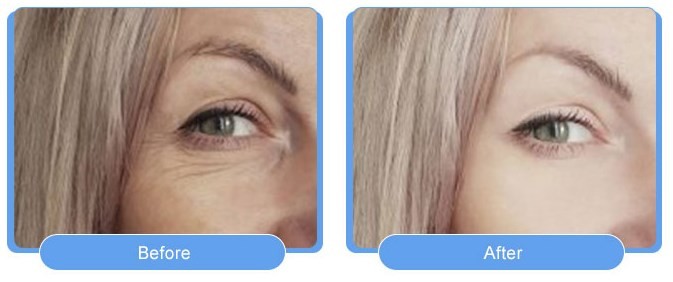 Тип Botox ботулизма удаления морщинки Hyamely впрыска BTX
