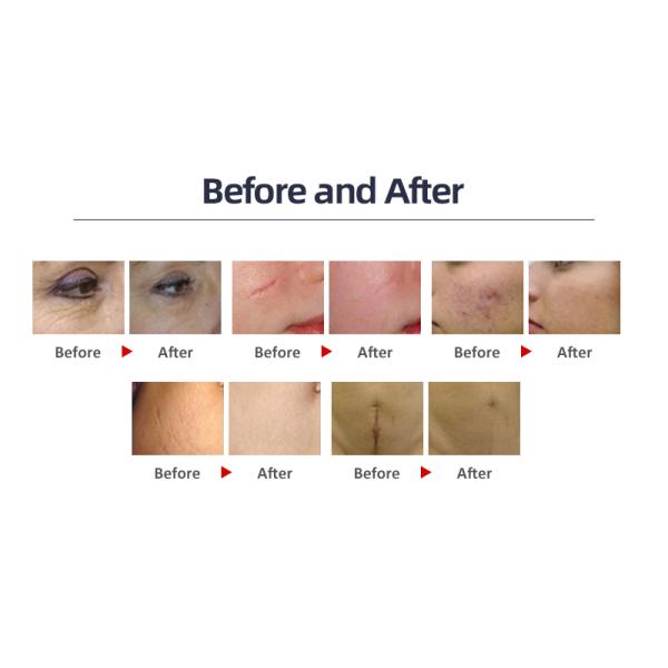 Коммерческая лазерная машина для восстановления кожи с углекислым газом 10600 нм