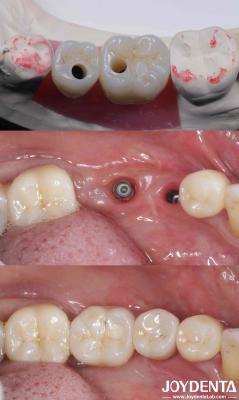 Cylindrical All On 4 Titanium Dental Implants 10-16mm Length Hex Connection