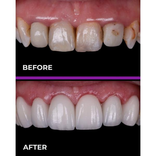 блок Zirconia CAD CAM пробела Zirconia 3D 25mm Pro разнослоистый керамический