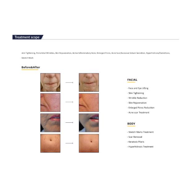 Body Fractional Micro Needle RF Frequency Microneedle 49 Pin Beauty Machine Body Equipment with Vacuum