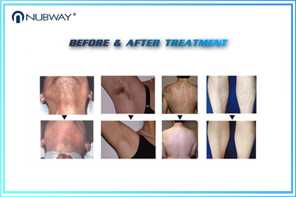 Medical laser manufacturer germany 20*12 big spot 808nm Diode Laser hair Removal