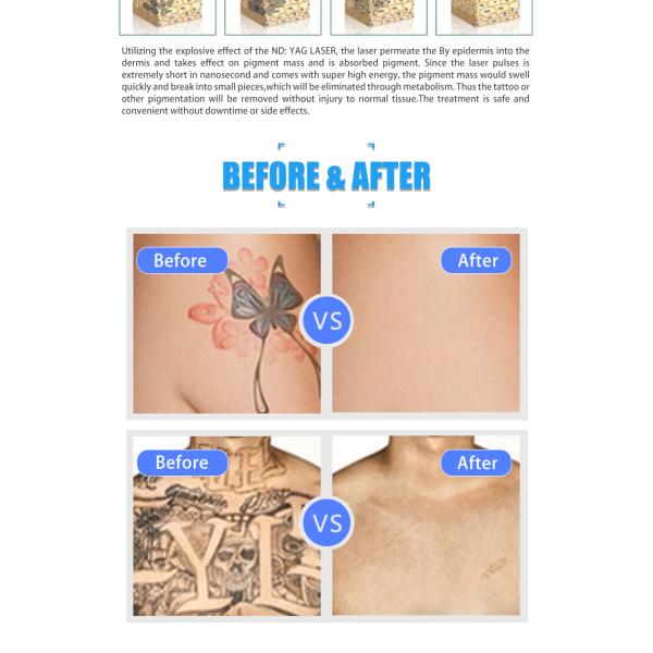 Услуги по удалению татуировок с помощью лазерной машины Q Switched Nd Yag