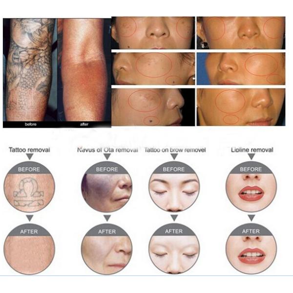 Medical Beauty ND YAG Laser Machine Laser Hair And Tattoo Removal Machine