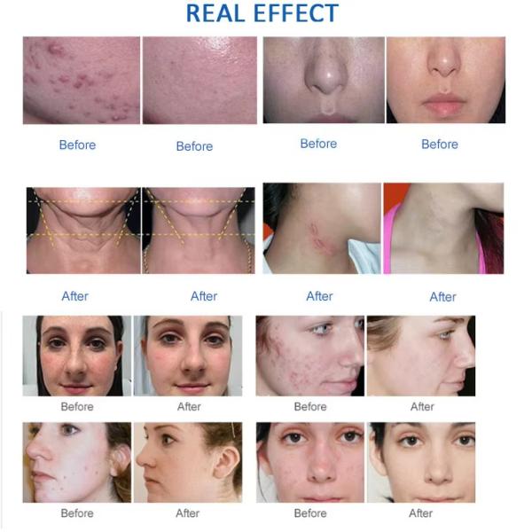 Dual Photodynamic Skin Whitening PDT LED Red Light Therapy  Machine
