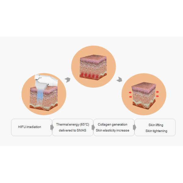 Anti Aging Home Hifu Machine 3mm - 6mm Standard Handpieces Fast Access