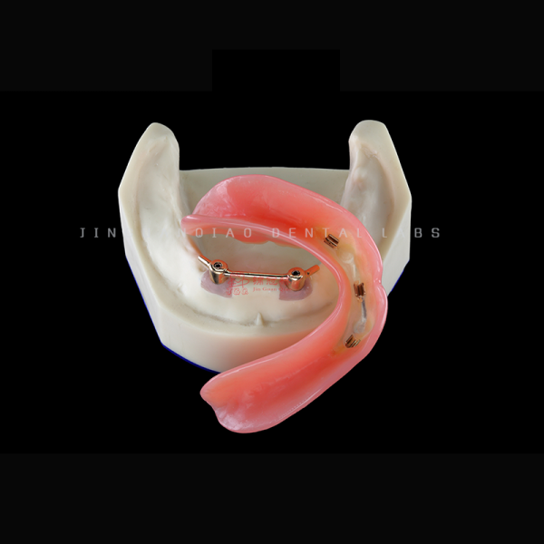 Removable Denture Cobalt Chrome Precision Milled Attachments with Acrylic Teeth