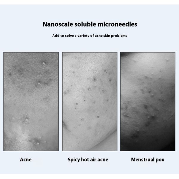 Single Sided Painless Microneedle Acne Patch Microcrystals Water Activated PE Adhesive Sticker for Masking Use