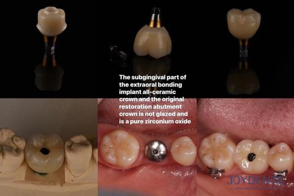 Ultra Hard Colour Stability Dental Implant Crown OEM Easy Maintain Long Lasting