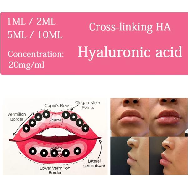 Крест стороны 1ml соединил впрыску дермального натрия заполнителя Hyaluronic кисловочную