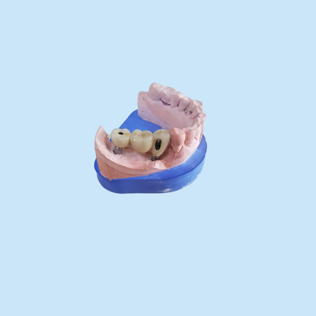 Крона Zirconia CAD CAM зубоврачебная с устоем Zirconia основания титана