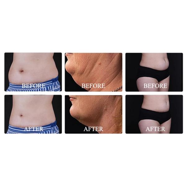 6 In 1 Monopolar Vacuum 40k Cavitation Machine For Weight Loss Skin Tightening