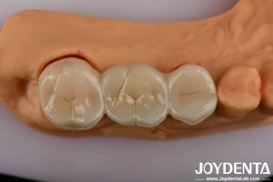 High Strength Dental Zirconia Your Ultimate Solution For Natural-looking