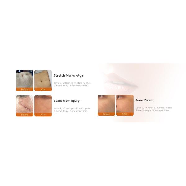 Высококачественная машина Rf Microneedle вакуума Rf Microneedling радиочастоты Microneedling удаления угорь