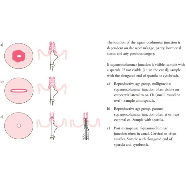 HPV Testing Disposable Cytology Brush , 200mm Pap Smear Broom