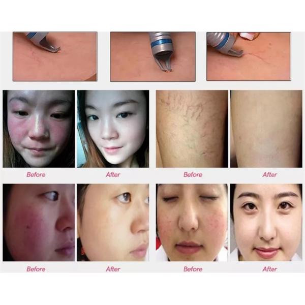 Удаление пауковых вен с 980-нм диодным лазером