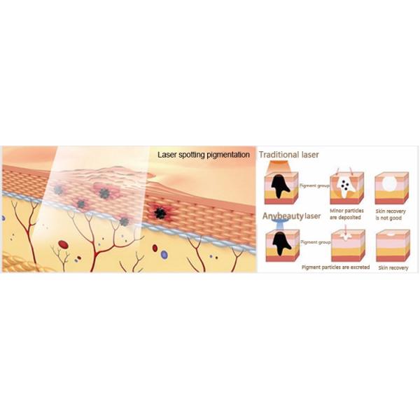 1064nm 532nm Q Switched Nd Yag Laser Tattoo Removal Machine F12 For Pigments Removal