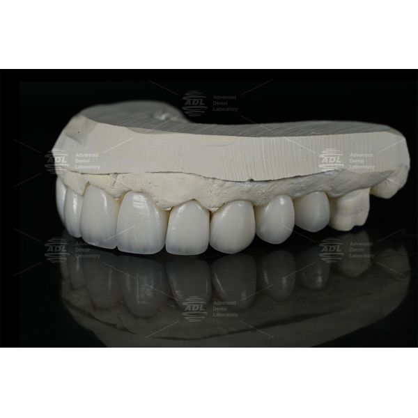 0.3mm-0.7mm Feldspathic EMAX Ceramic Veneers Natural Aesthetic Emax Dental Veneers