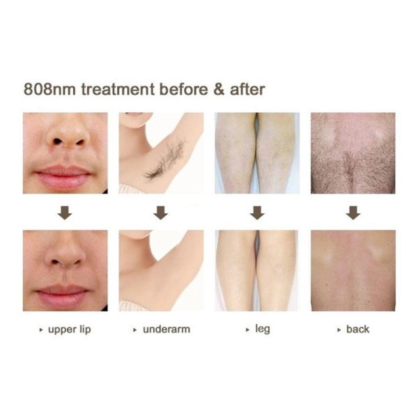 Удаление волос лазера диода удаления 808nm татуировки Nd Yag и лазер 2 Pico в 1
