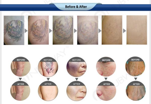 Hot selling salon use Q-Switched ND: YAG Laser Tattoo Removal Machine