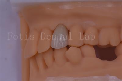 3 Shape/Exo Design Digital Dental Crowns Better Fit And Less Discomfort