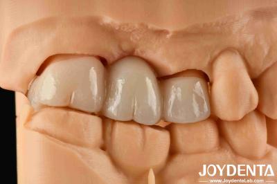 Experience Color Realistic Full Zirconia With High Resistance To Staining And Flexural Strength Of 1000 MPa