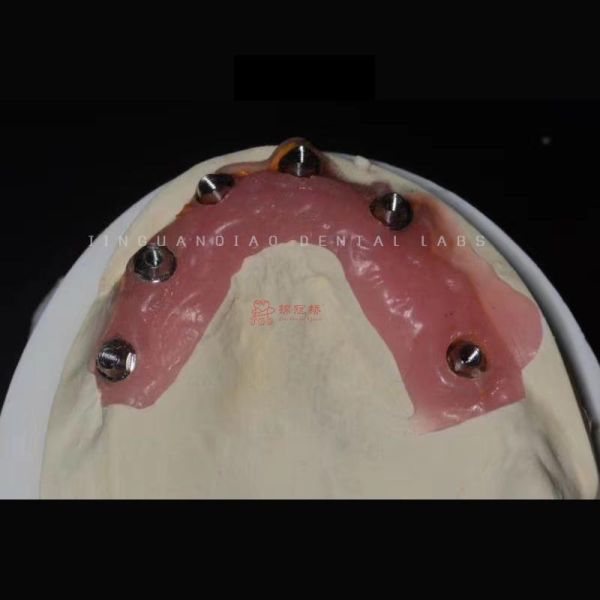 Snap in Implant Dentures Hybrid Dental Implant Restoration Screwed Retention for Dental Lab