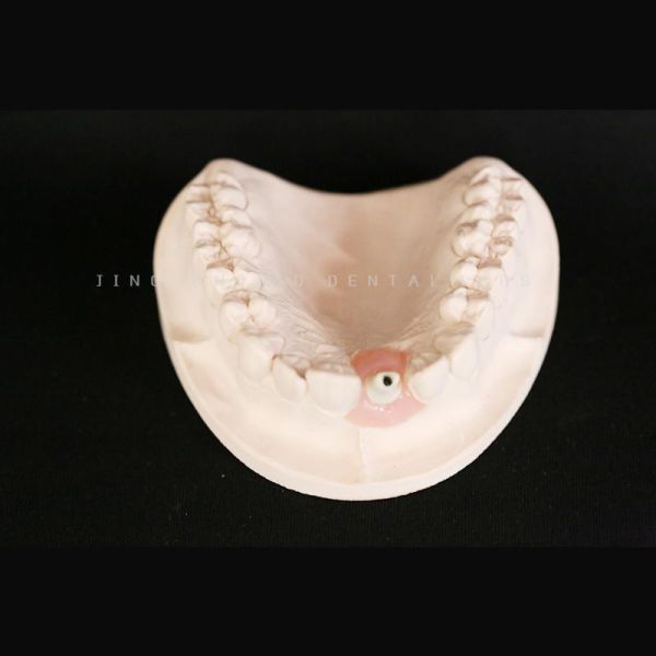 Dental Zirconia Custom Abutment Lab Precise Esthetical As Strong As Titanium