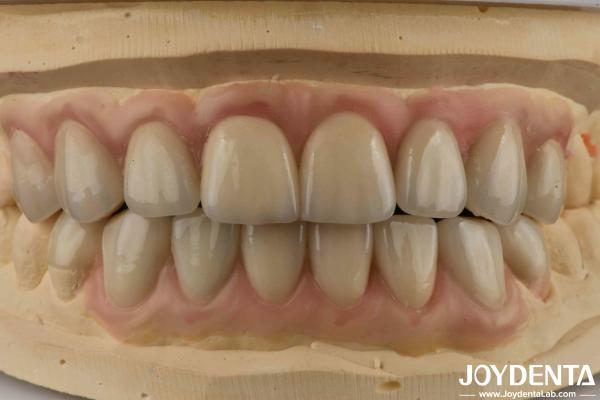 High Translucency Emax Cosmetic Dentistry Veneers High Aesthetics Ultra Thin