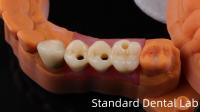 Laboratoire dentaire professionnel de la couronne d'implant dentaire en zircone en titane CAD CAM