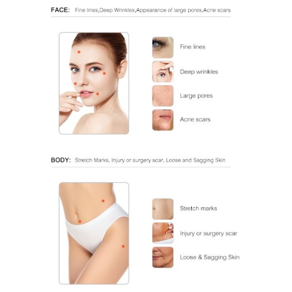 Non Surgical Skin Rejuvenation RF Microneedle Machine Radio Frequency 1-50W