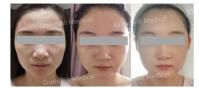 Le miracle de propulseur de peau de l'acide hyaluronique PCL touchent le stimulateur de collagène de peau