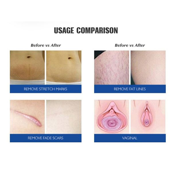 Q переключил частичный лазер СО2 применяет обложку к Resurfacing машина 10600nm