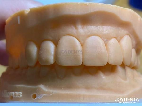 Lightweight and Smooth Dental Veneers Stain Resistance Long-lasting Durability for Optimal Comfort