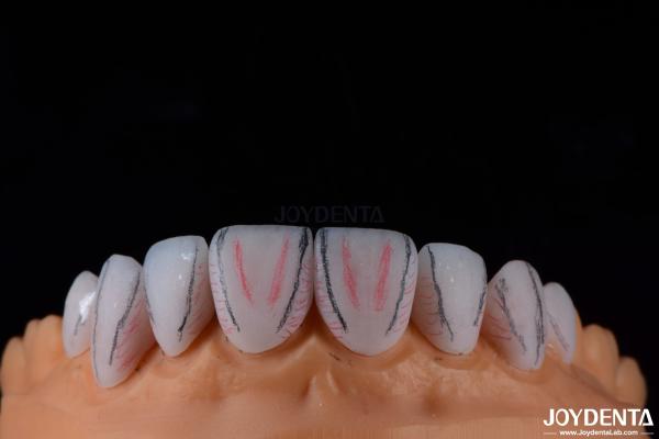 Custom Made Dental Emax Ceramic Veneers With Stain Resistance High Gloss