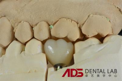 Dental Teeth Full Mouth Zirconia Implants Abutment Custom CAD CAM