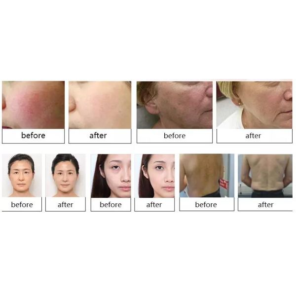 360 Magneto Optic OPT SHR Elight IPL Beauty Machine For Hair Removal / Skin Rejuvenation