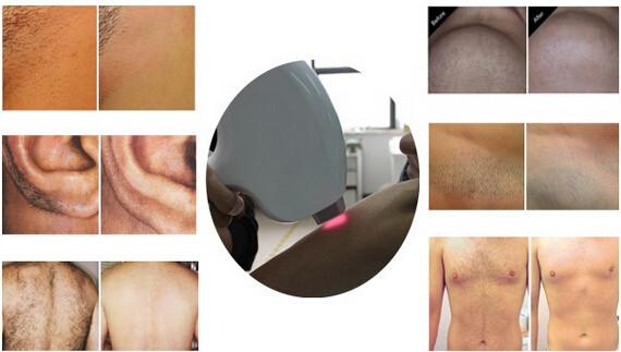 Cheapest best new professional powerful germany dioder laser bar for hair removal