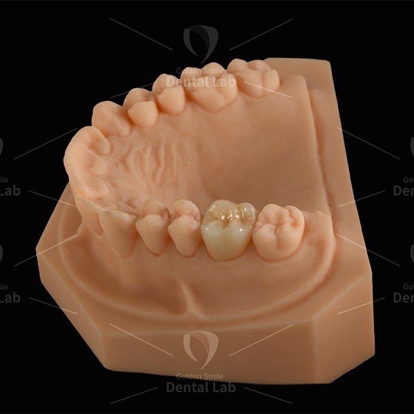 Monolithic Full EMax Crown Lithium Disilicate Crown E Max Natural Translucency