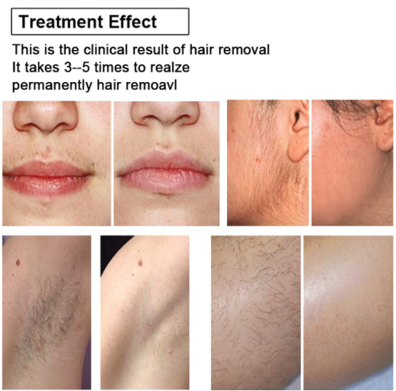 Stationary 808 Diode Laser Hair Removal Machine For 10 Bars Germany