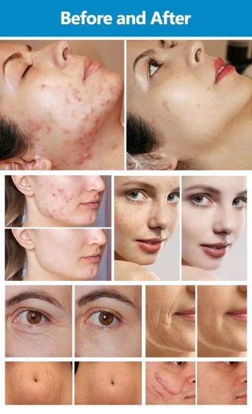 Fractional Co2 Laser Price Acne Scar Removal Product Stainless Brass Carbon Steel Laser Cutting Machine