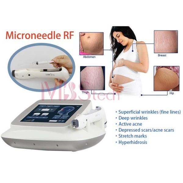 Vergetures de retrait de visage de machine du levage rf Microneedle