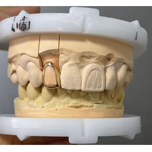 Dental Crwons And Bridges