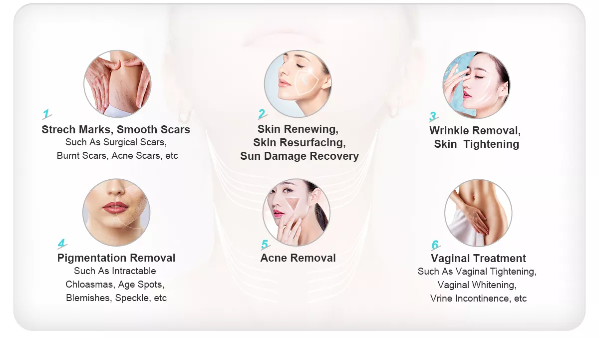 Машина лазера RF СО2 частичная для удаления угорь обработки стороны