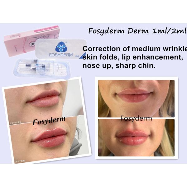 Éliminez l'acide hyaluronique cutané ha réticulé par injection de remplisseur de gel de Fosyderm de ride