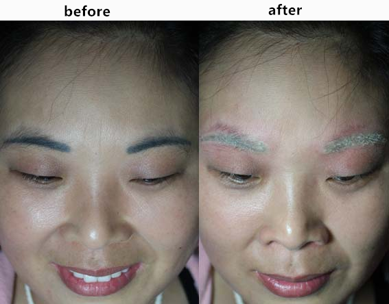 Permanent ipl laser hair removal Machine , nd yag laser tattoo removal