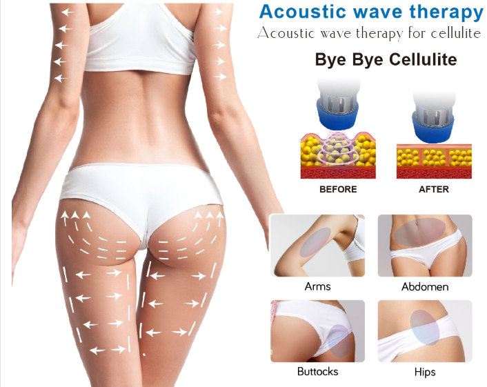 Pain Treatment Physical 80KPa Shockwave Therapy Equipment