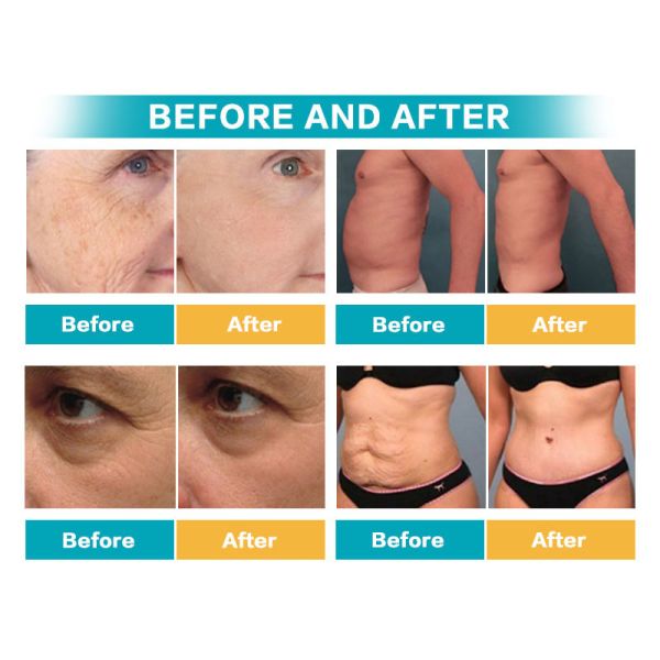 Машина потери веса 7D HIFU, машина липосакции удаления морщинки не инвазионная